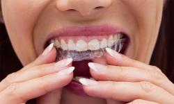 Logo - Ortodoncia Invisible